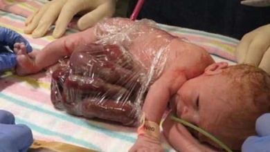 Medico aconselhou mãe à abortar, mas ela não fez. Veja como ele nasceu!