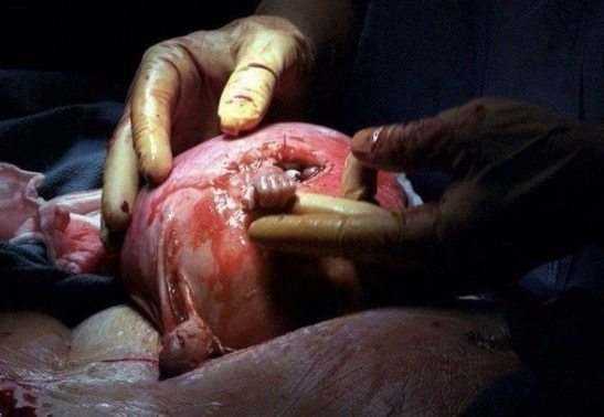 Feto agarra médico de dentro do útero, com apenas 21 semanas. 16 anos depois, isso foi o que aconteceu com o bebê.