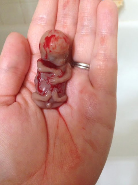 Mulher sofre aborto espontâneo e posta foto do bebê de 11 semanas com uma mensagem chocante, veja