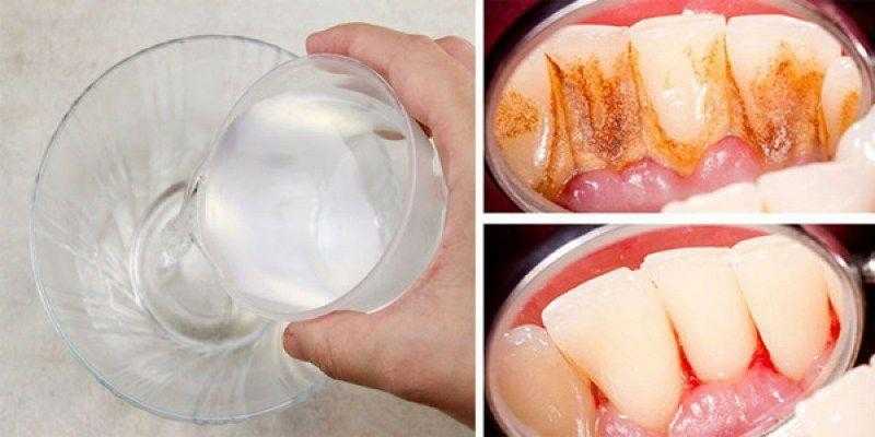 Elimine a placa bacteriana-tártaro e ainda clareia os dentes 1