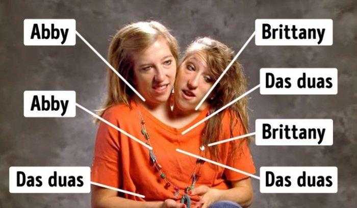 Como estão as irmãs siamesas mais famosas do mundo: “Abby e Brittany”