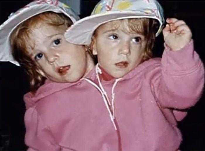 Como estão as irmãs siamesas mais famosas do mundo: “Abby e Brittany”